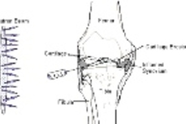 The researchers inject a boron compound into an arthritic joint and expose the joint to neutrons. The boron captures some of the neutrons to form a radioactive substance that kills the inflamed synovium, represented by the gray spots.