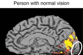 Images of human brains, based directly on data from an MRI machine, show the regions of the brain that are activated by peripheral visual stimuli in a person with normal vision and in a person with macular degeneration. People with macular degeneration lack central vision and must use peripheral vision only. The area at the back of the brain (marked by the white ovals) that normally responds only ...