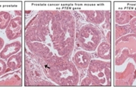 The image on the left shows a sample from a normal prostate, with organized cells lining the O-shaped ductules. Â Mice without theÂ PTENÂ gene had developed cancer, which is characterized by enlarged glands and disorganized cells clogging the ductules (middle image). Â When mTORC2 activity is blocked in mice lacking the PTENÂ gene, the prostate ductulesÂ resemble the appearance of norm...