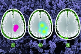 A team of researchers hopes to extend patients’ lifespan by delivering directly to the brain a drug that targets a mutation found in 20 to 25 percent of all gliomas.