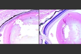 At left, photoreceptor cells of the retina have undergone severe damage after treatment with an alkylating agent. This damage is exacerbated by the DNA repair enzyme Aag. At right, photoreceptor cells lacking Aag appear normal following treatment with the alkylating agent.