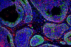 In these tumor cells, acidic regions are labeled in red. Invasive regions of the cells, which express a protein called MMP14, are labeled in green.