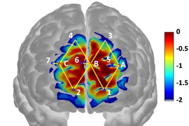 Researchers from MIT and elsewhere have developed a system that detects pain in patients by analyzing brain activity from a wearable neuroimaging device, which could help doctors diagnose and treat pain in unconscious and noncommunicative patients. 