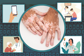 the skin disease vitiligo and app graphics